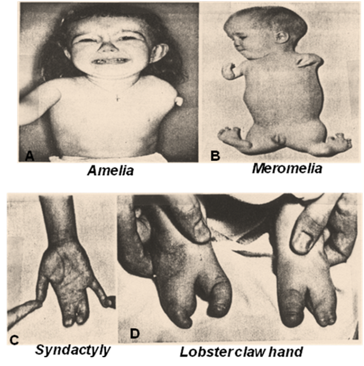 7935596 orig Limb development in a nutshell Pediatrics